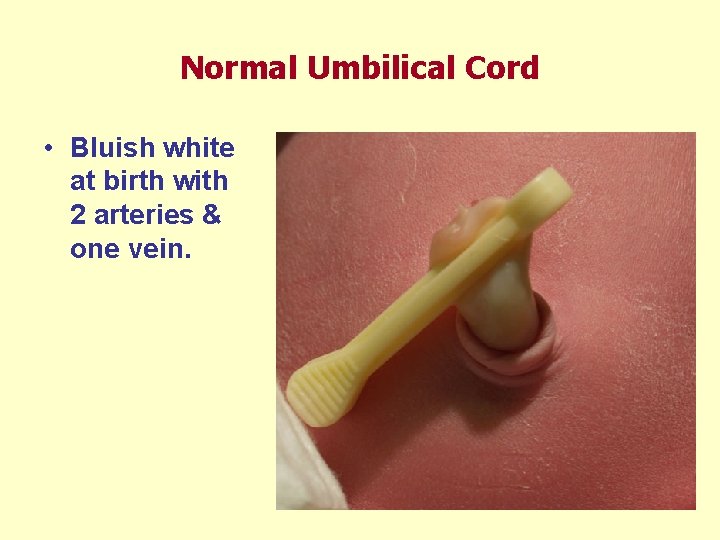 Normal Umbilical Cord • Bluish white at birth with 2 arteries & one vein.