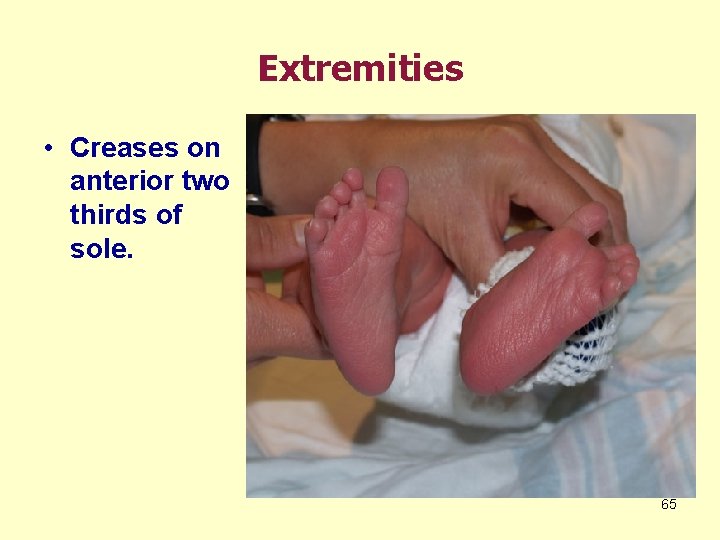 Extremities • Creases on anterior two thirds of sole. 65 