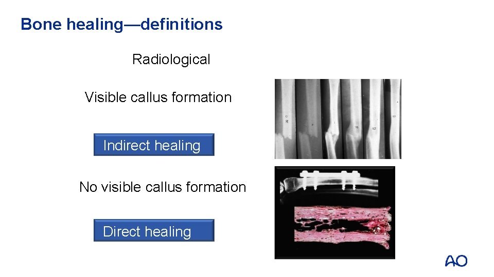Bone healing—definitions Radiological Visible callus formation Indirect healing No visible callus formation Direct healing