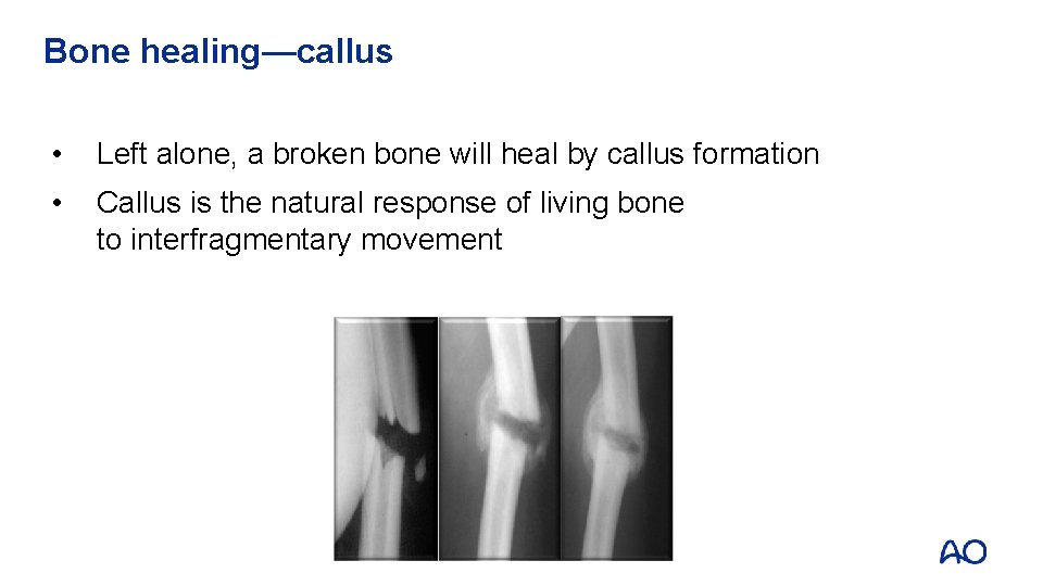 Bone healing—callus • Left alone, a broken bone will heal by callus formation •