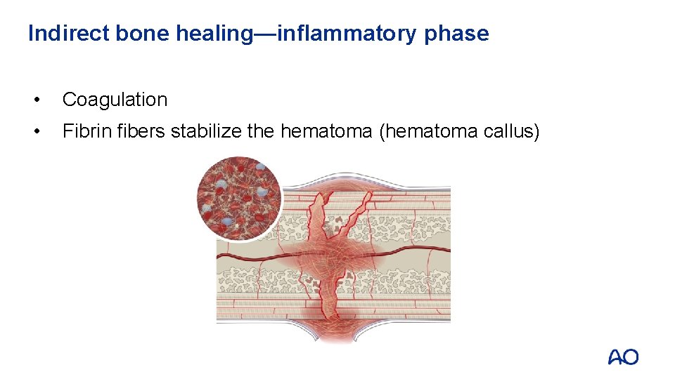 Indirect bone healing—inflammatory phase • Coagulation • Fibrin fibers stabilize the hematoma (hematoma callus)