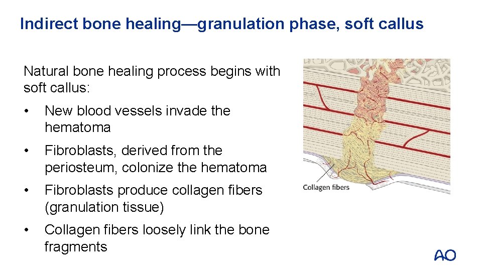 Indirect bone healing—granulation phase, soft callus Natural bone healing process begins with soft callus: