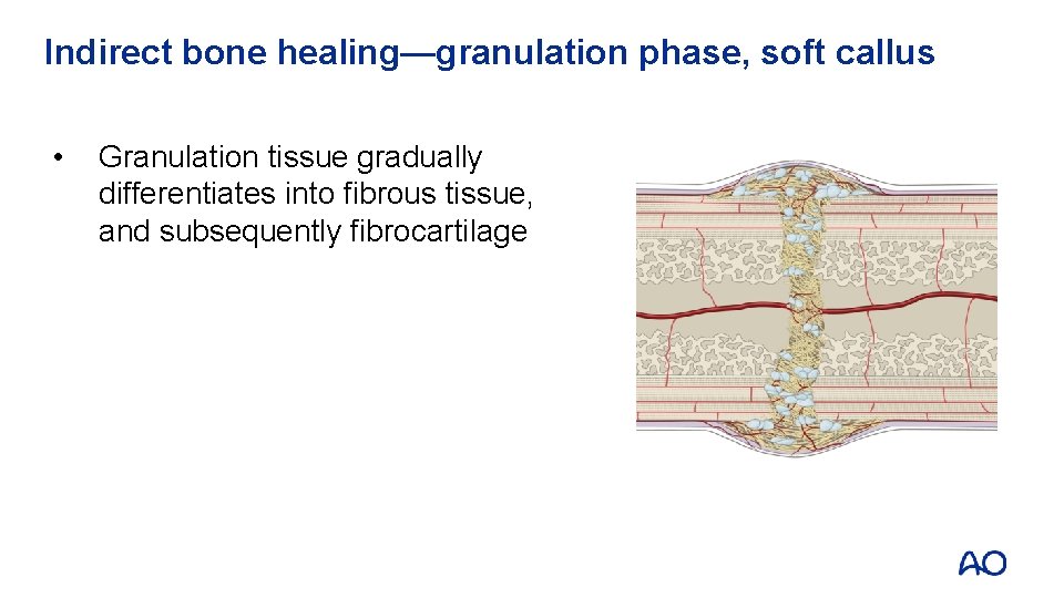Indirect bone healing—granulation phase, soft callus • Granulation tissue gradually differentiates into fibrous tissue,
