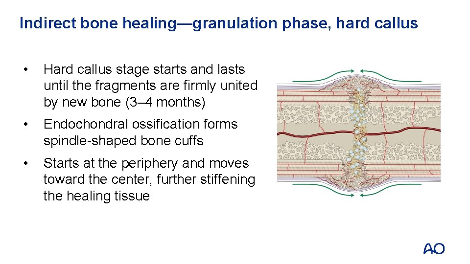 Indirect bone healing—granulation phase, hard callus • Hard callus stage starts and lasts until
