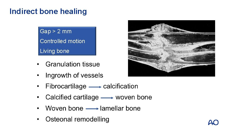 Indirect bone healing Gap > 2 mm Controlled motion Living bone 