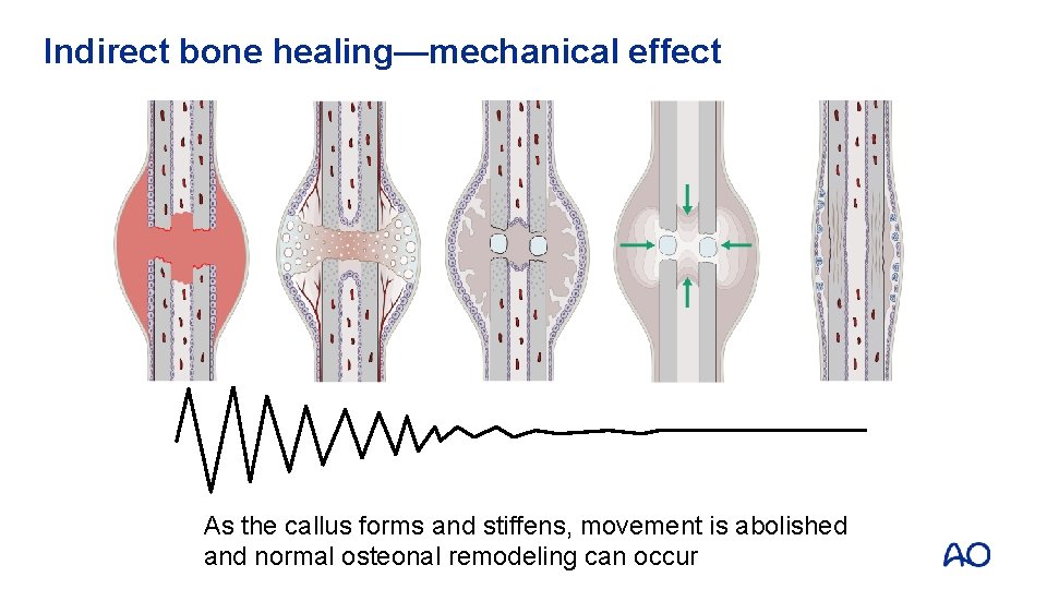 Indirect bone healing—mechanical effect As the callus forms and stiffens, movement is abolished and