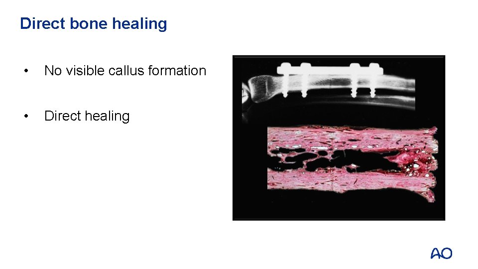 Direct bone healing • No visible callus formation • Direct healing 