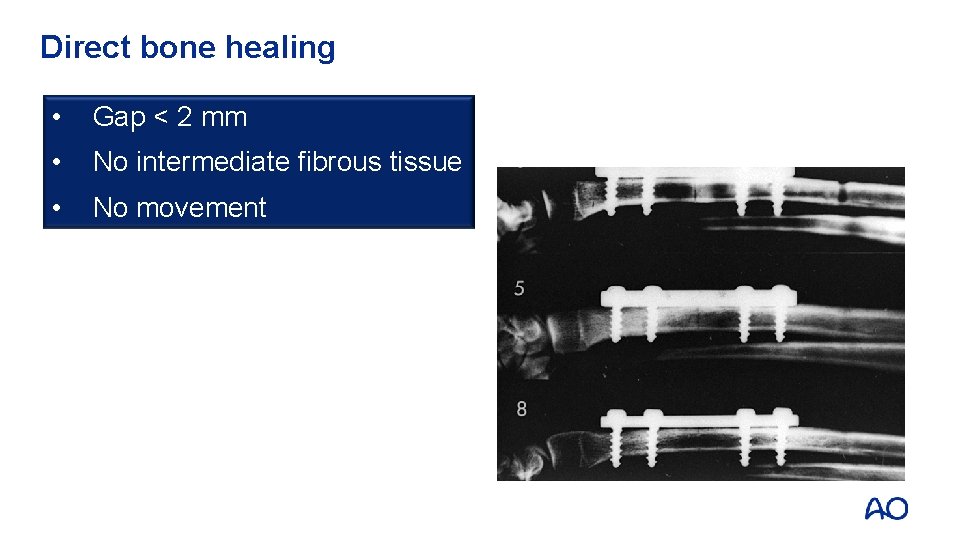 Direct bone healing • Gap < 2 mm • No intermediate fibrous tissue •