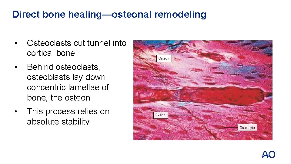 Direct bone healing—osteonal remodeling • Osteoclasts cut tunnel into cortical bone • Behind osteoclasts,