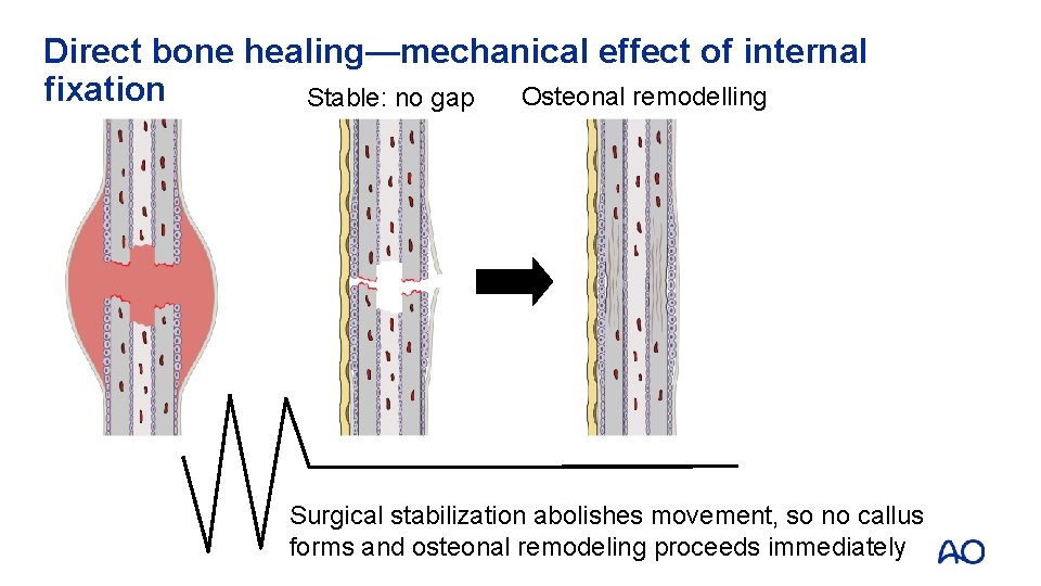 Direct bone healing—mechanical effect of internal fixation Osteonal remodelling Stable: no gap Surgical stabilization