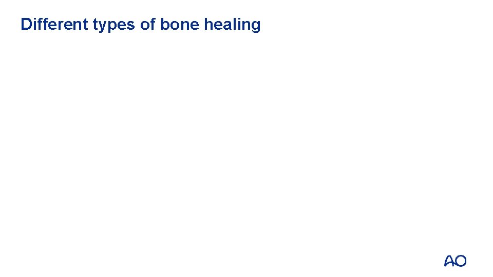 Different types of bone healing 