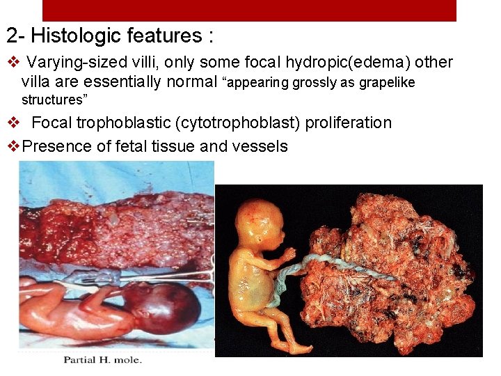 2 - Histologic features : v Varying-sized villi, only some focal hydropic(edema) other villa