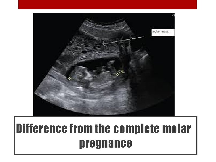 Difference from the complete molar pregnance 