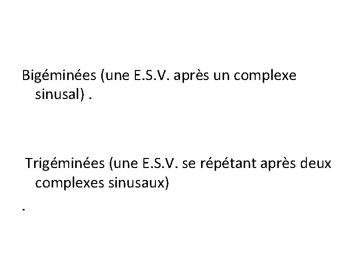 Bigéminées (une E. S. V. après un complexe sinusal). Trigéminées (une E. S. V.