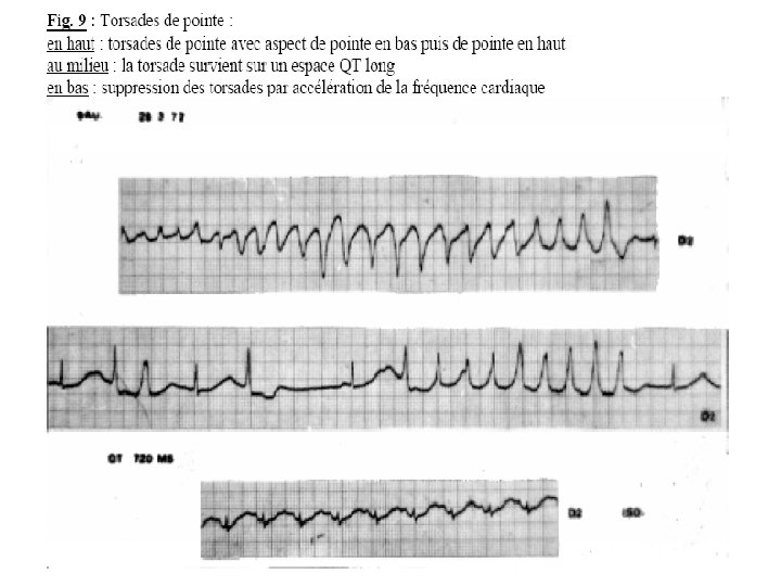 Bloc Auriculo-Ventriculaire : BAV 