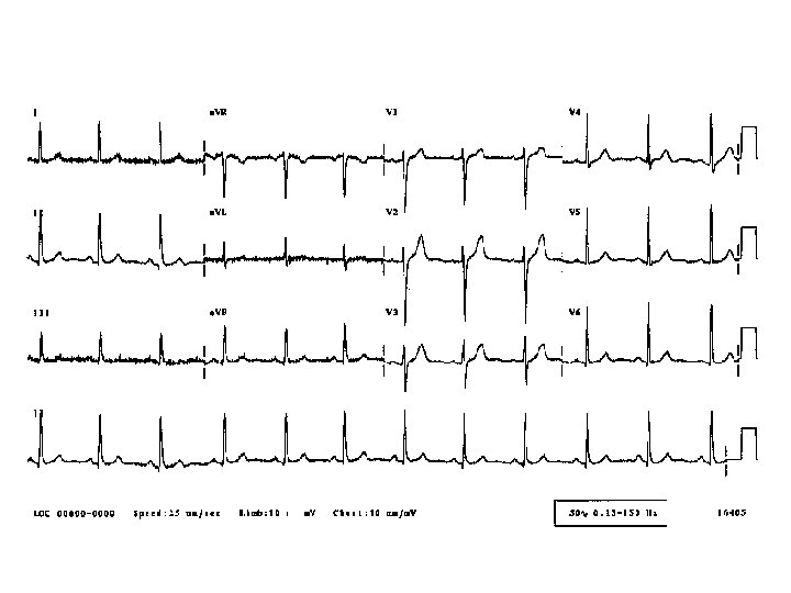 ECG normal 