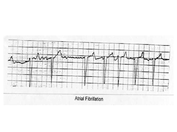 Flutter Fibrillation auriculaire 