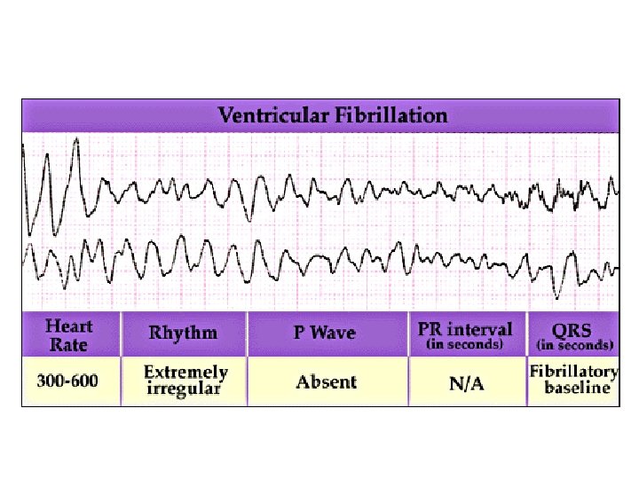 Fibrillation Ventriculaire (2) 