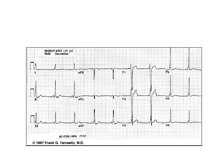 Syndrome de Wolff-Parkinson-White (wpw) (4) 