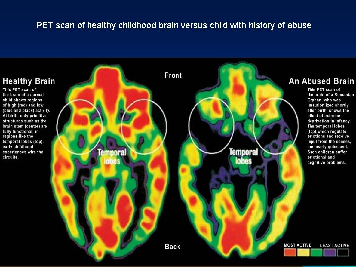 PET scan of healthy childhood brain versus child with history of abuse Creating Cultures