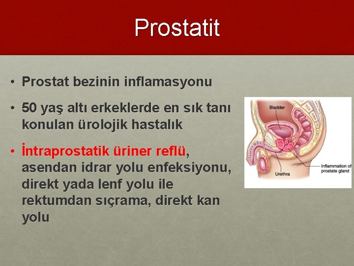 Prostatit • Prostat bezinin inflamasyonu • 50 yaş altı erkeklerde en sık tanı konulan