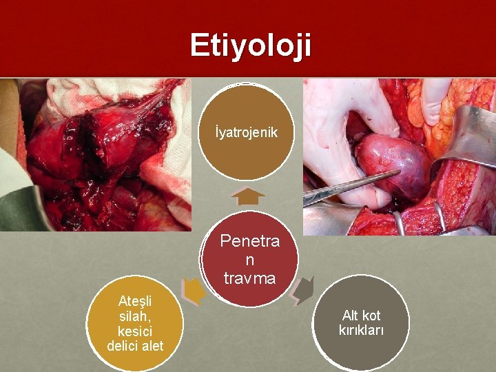 Etiyoloji Trafik İyatrojenik kazaları Künt Penetra n travma (%90) Ateşli silah, Darbeler kesici delici