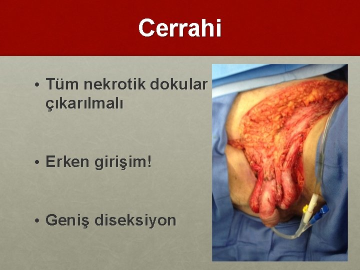 Cerrahi • Tüm nekrotik dokular çıkarılmalı • Erken girişim! • Geniş diseksiyon 