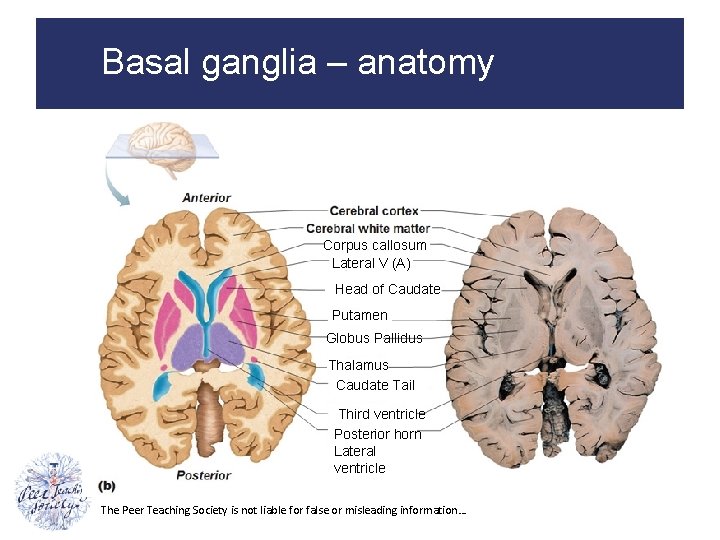 Basal ganglia – anatomy Corpus callosum Lateral V (A) Head of Caudate Putamen Globus