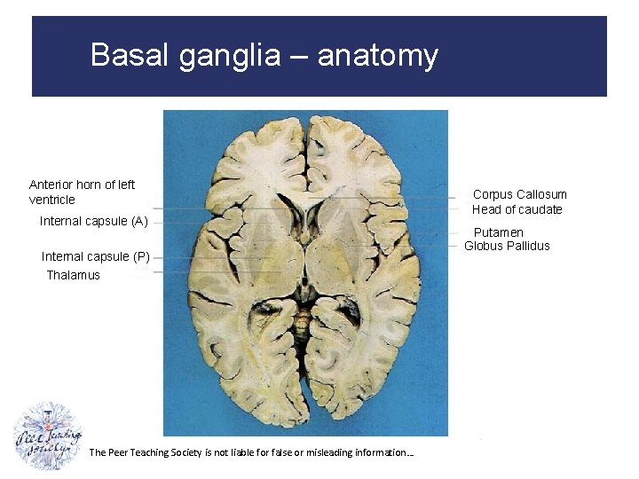 Basal ganglia – anatomy Anterior horn of left ventricle Internal capsule (A) Internal capsule