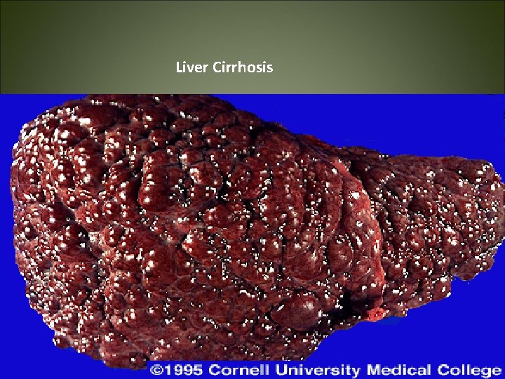 Liver Cirrhosis 