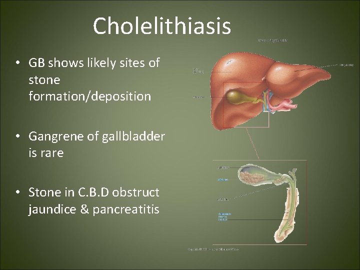 Cholelithiasis • GB shows likely sites of stone formation/deposition • Gangrene of gallbladder is