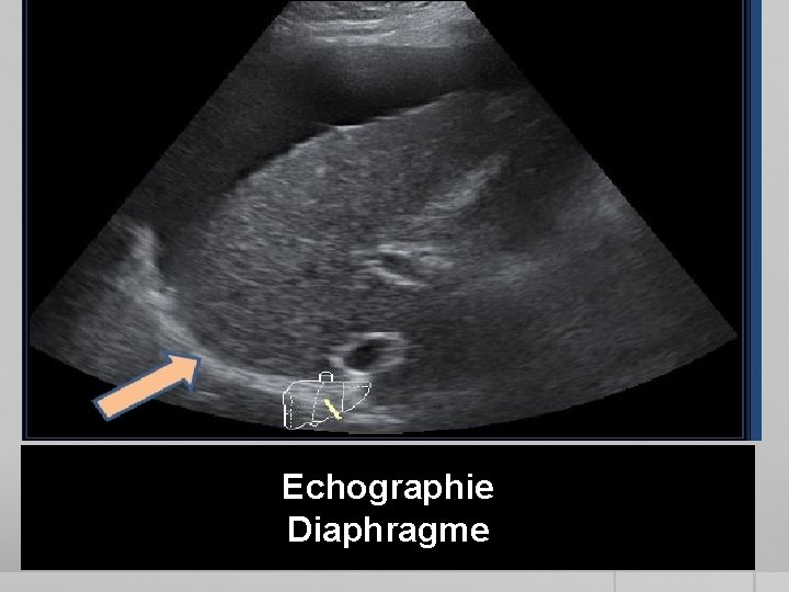 Echographie Diaphragme 