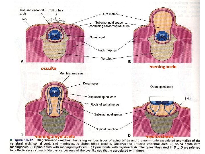 occulta meningomyelocele meningocele myeloschesis 