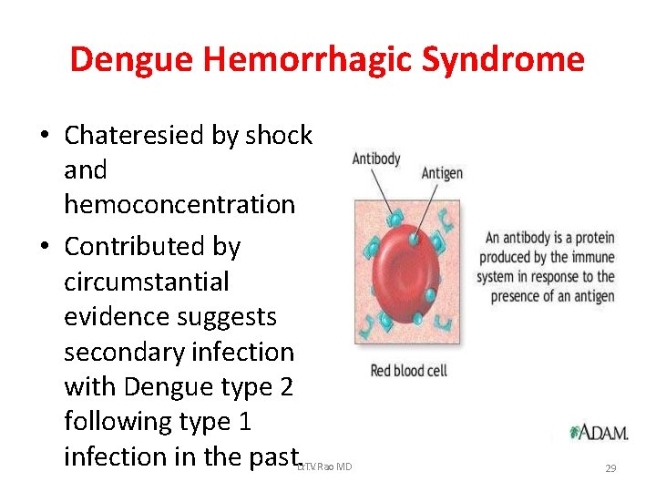 Dengue Hemorrhagic Syndrome • Chateresied by shock and hemoconcentration • Contributed by circumstantial evidence