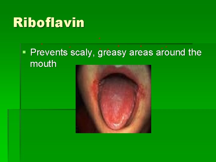 Riboflavin § Prevents scaly, greasy areas around the mouth 