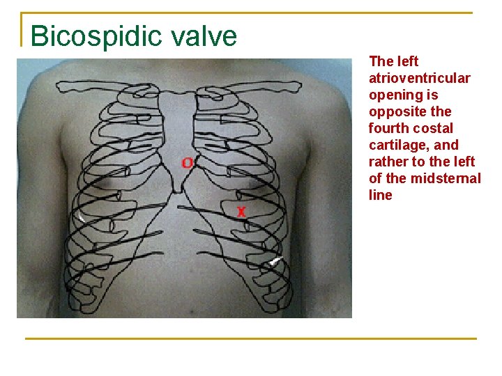 Bicospidic valve The left atrioventricular opening is opposite the fourth costal cartilage, and rather