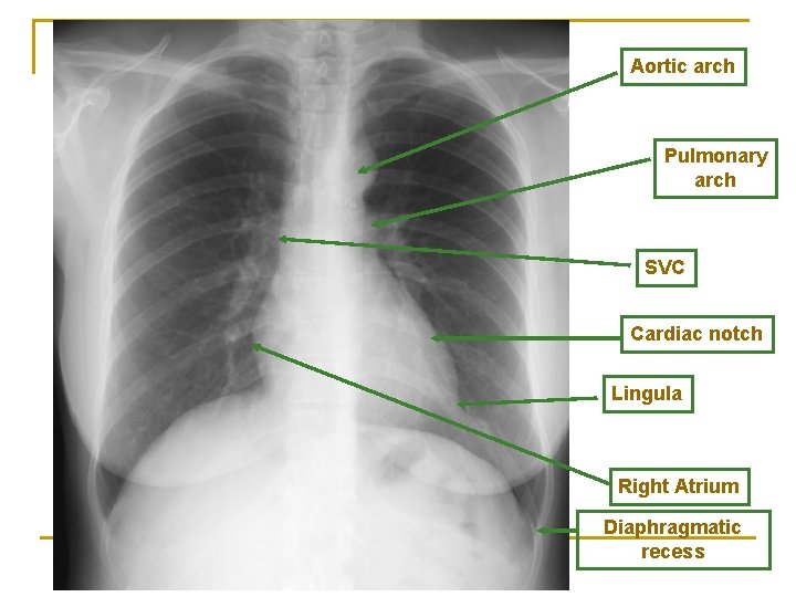 Aortic arch Pulmonary arch SVC Cardiac notch Lingula Right Atrium Diaphragmatic recess 