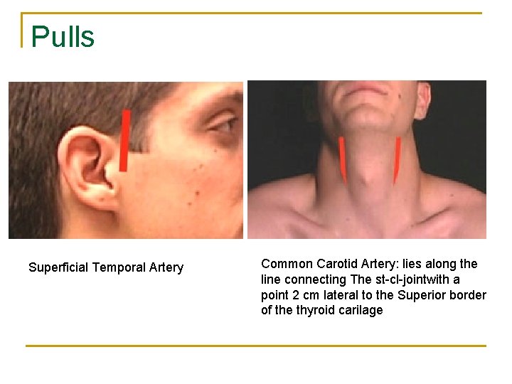 Pulls Superficial Temporal Artery Common Carotid Artery: lies along the line connecting The st-cl-jointwith