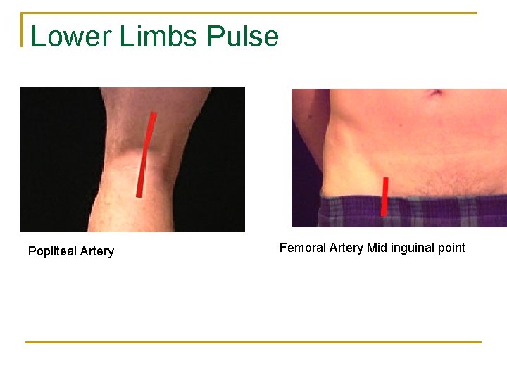 Lower Limbs Pulse Popliteal Artery Femoral Artery Mid inguinal point 