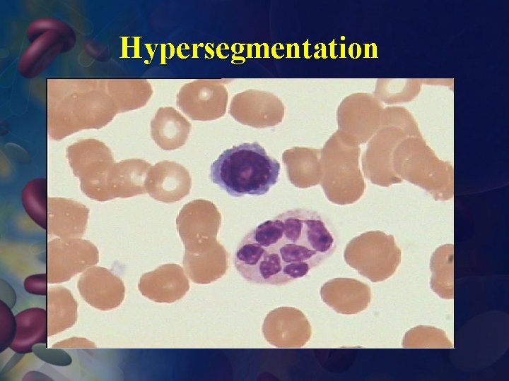 Hypersegmentation 