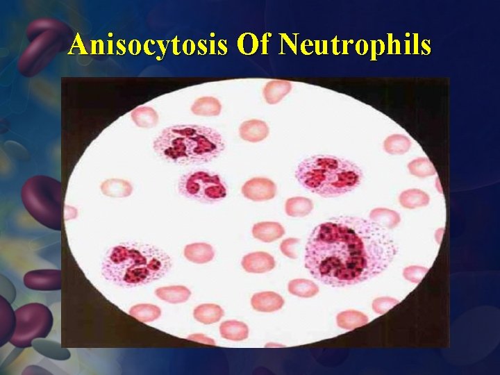Anisocytosis Of Neutrophils 