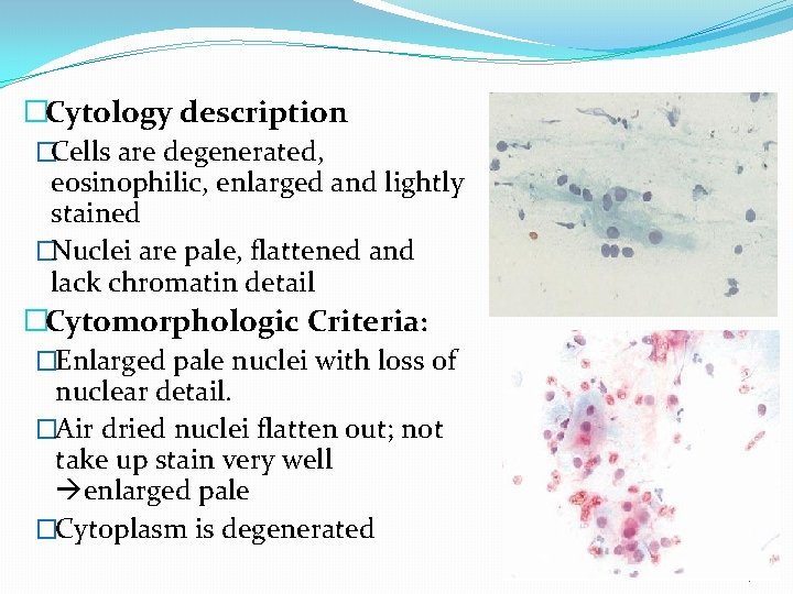 �Cytology description �Cells are degenerated, eosinophilic, enlarged and lightly stained �Nuclei are pale, flattened