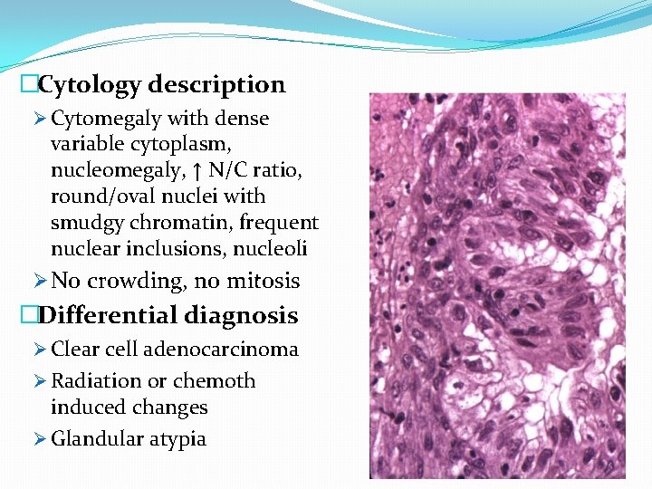 �Cytology description Ø Cytomegaly with dense variable cytoplasm, nucleomegaly, ↑ N/C ratio, round/oval nuclei