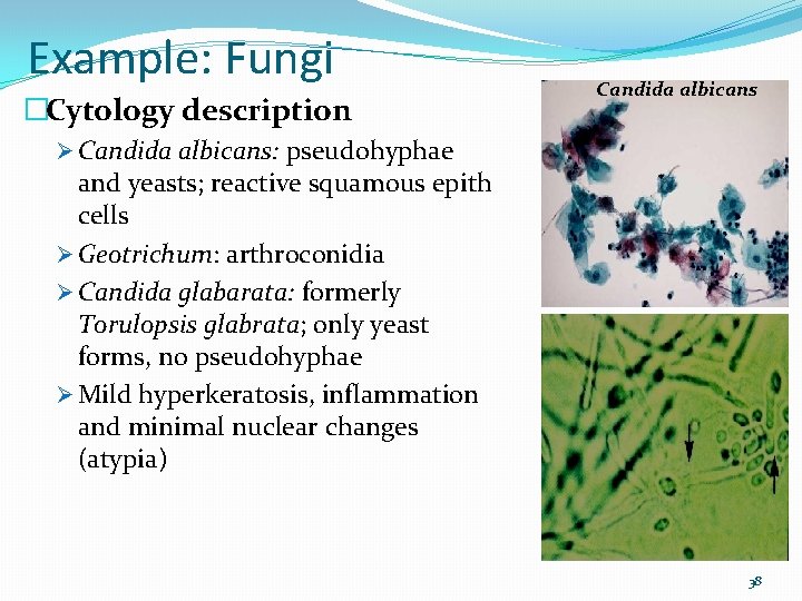 Example: Fungi �Cytology description Candida albicans Ø Candida albicans: pseudohyphae and yeasts; reactive squamous