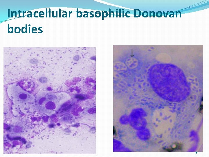 Intracellular basophilic Donovan bodies 01/01/2022 Cytology_ Gyn 40 