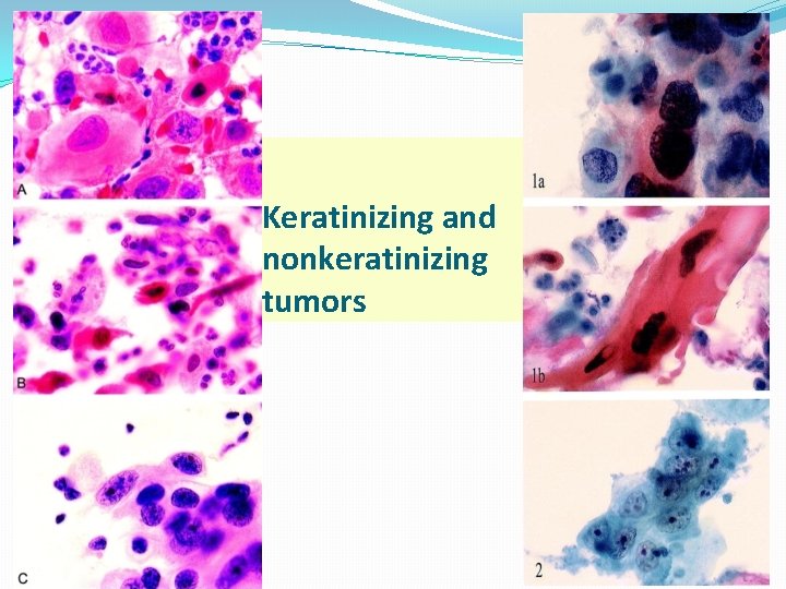 Keratinizing and nonkeratinizing tumors 01/01/2022 57 