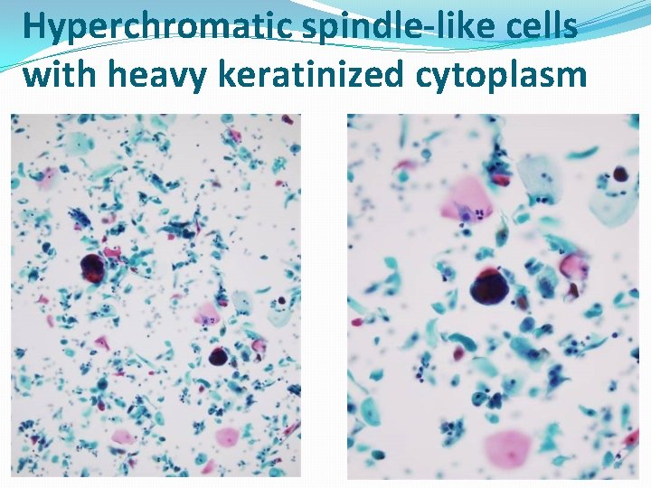 Hyperchromatic spindle-like cells with heavy keratinized cytoplasm 01/01/2022 Cytology_ Gyn 58 