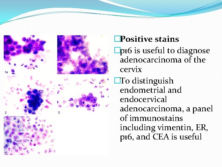 �Positive stains �p 16 is useful to diagnose adenocarcinoma of the cervix �To distinguish