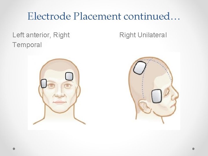 Electrode Placement continued… Left anterior, Right Temporal Right Unilateral 