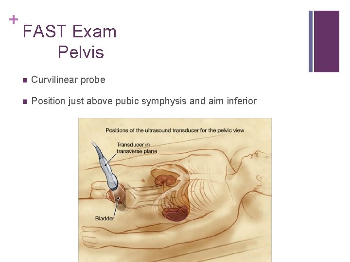 + FAST Exam Pelvis n Curvilinear probe n Position just above pubic symphysis and